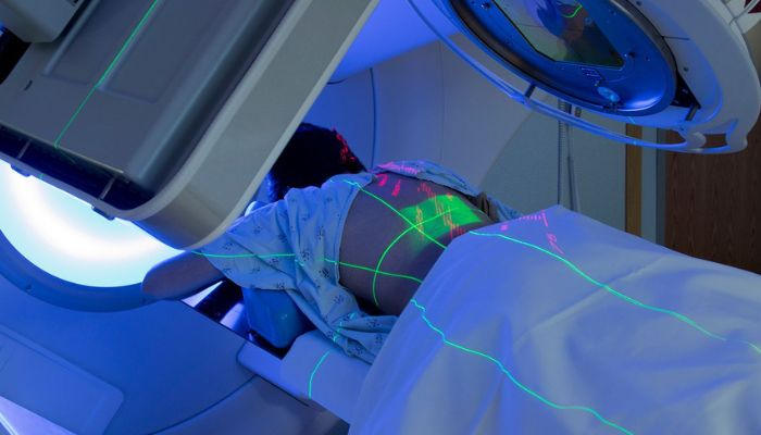 Blogs : Radiation therapy