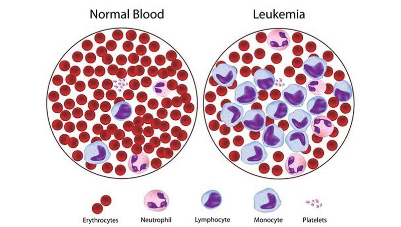 Blogs: Symptoms of Leukemia