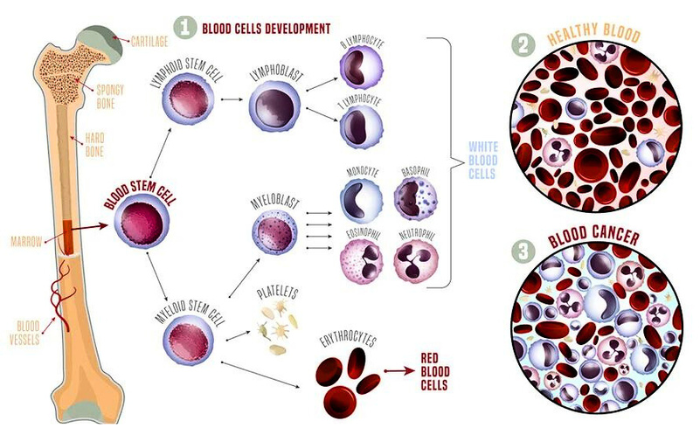 NSCRI Hospital Service - Bone marrow transplant in kolkata